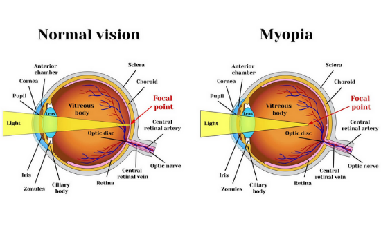 Myopia Diagram