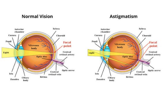 Astigmatism Daigram